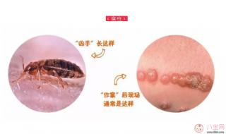 隐翅虫咬人后图片